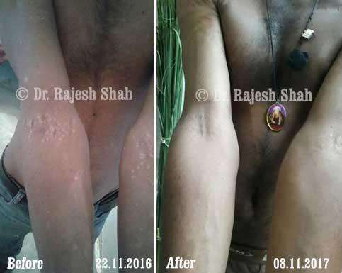 Psoriasis Before and After Case Photo