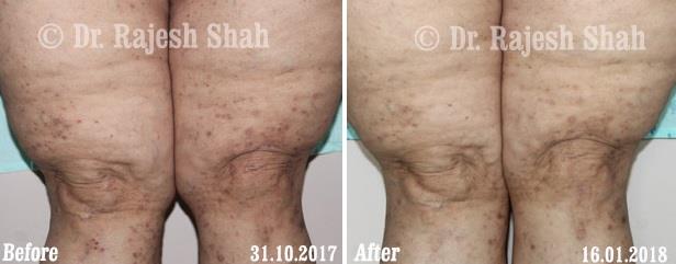 Lichen Planus Before and After Case Photo