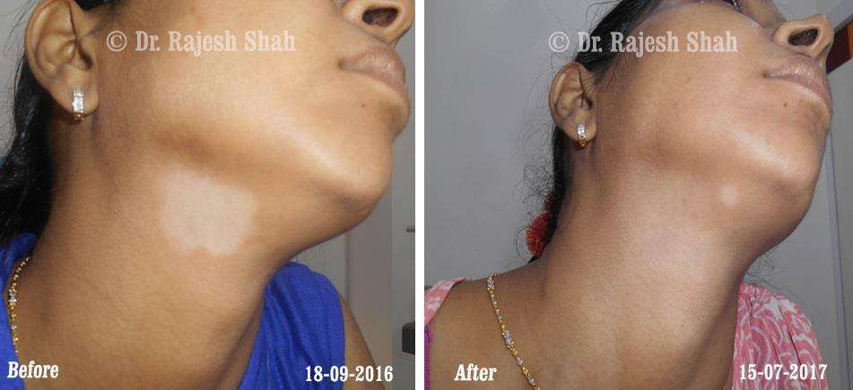 Vitiligo Before and After Case Photo