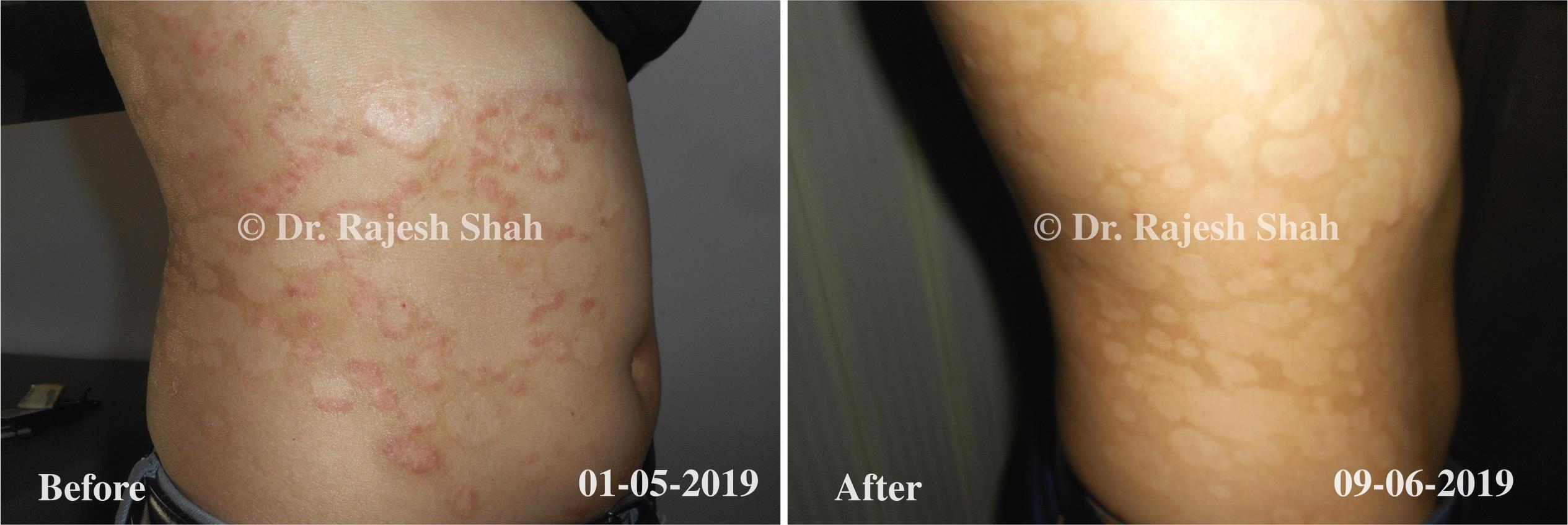 Psoriasis Before and After Case Photo