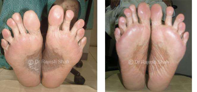 Lichen Planus Before and After Case Photo