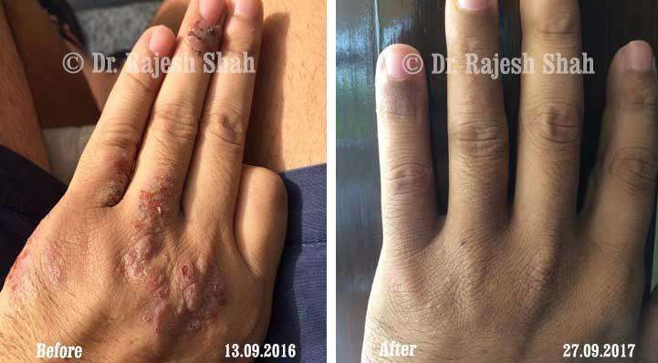 Atopic Dermatitis Before and After Case Photo