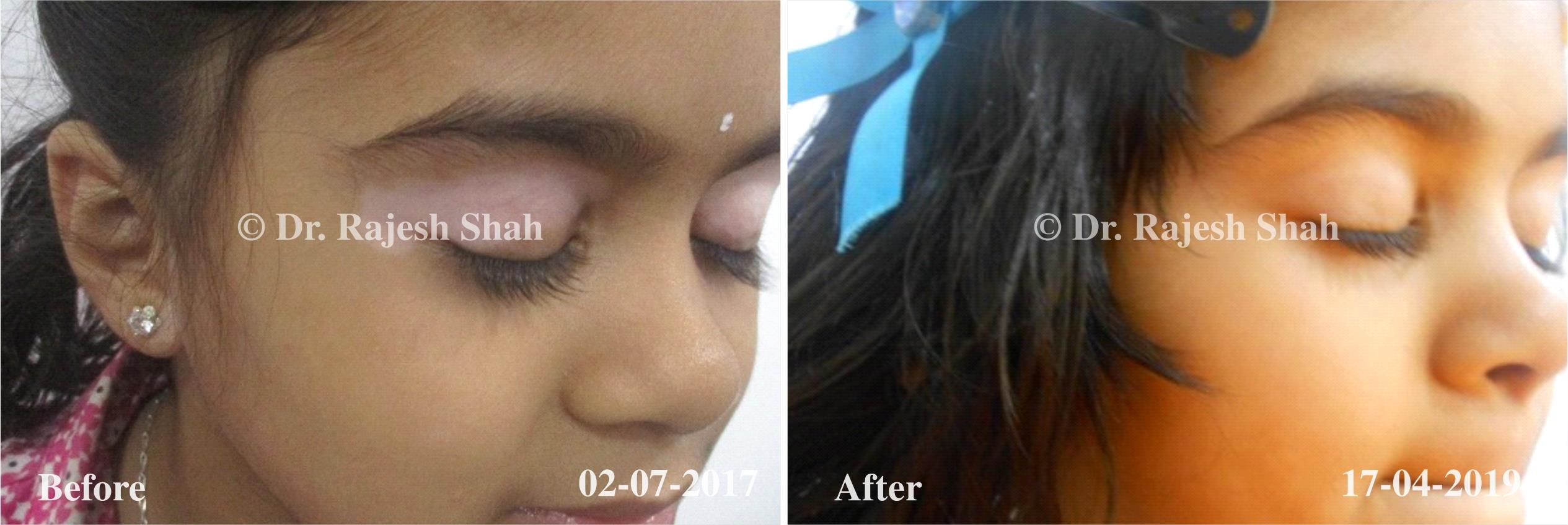 Vitiligo Before and After Case Photo