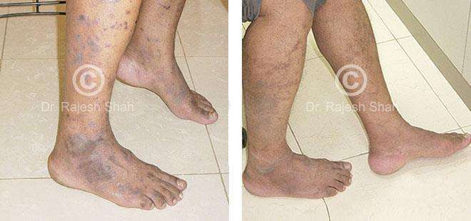 Lichen Planus Before and After Case Photo