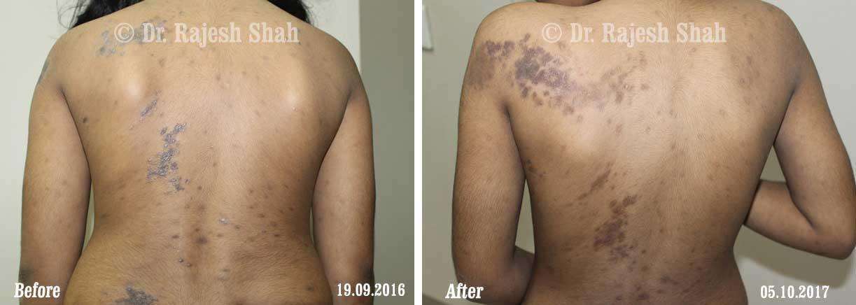 Lichen Planus Before and After Case Photo