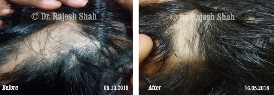 Alopecia Areata Before and After Case Photo