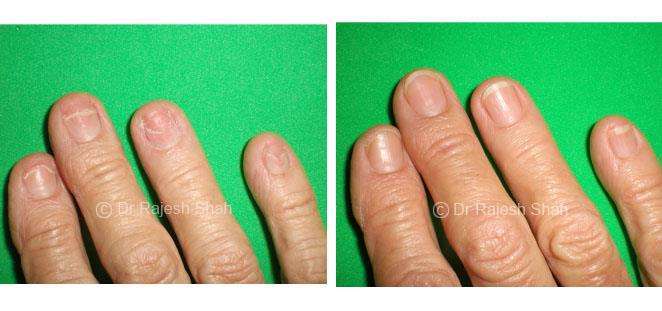 Lichen Planus Before and After Case Photo