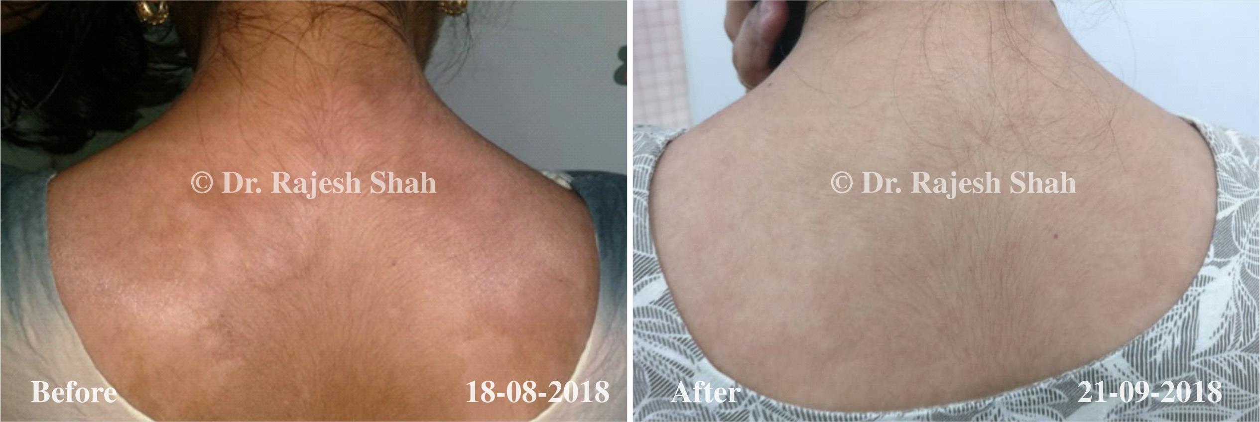 Psoriasis Before and After Case Photo