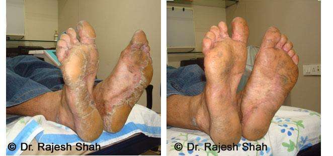 Psoriasis Before and After Case Photo