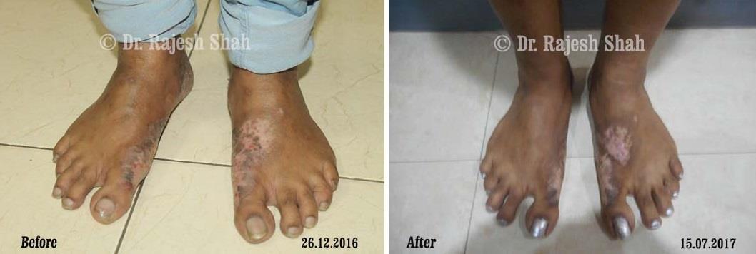 Psoriasis Before and After Case Photo