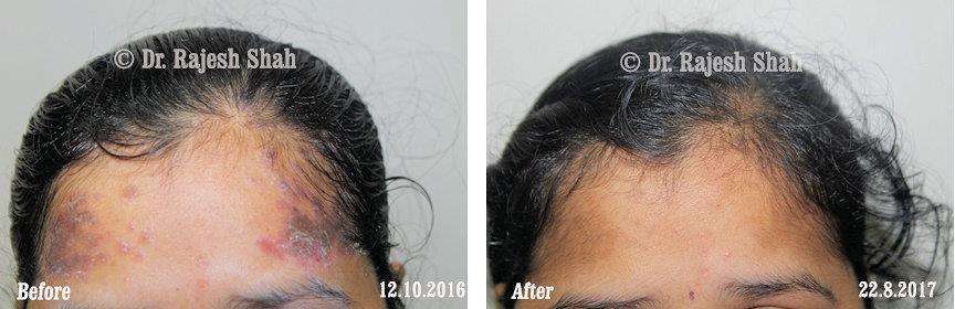 Psoriasis Before and After Case Photo