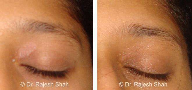 Psoriasis Before and After Case Photo