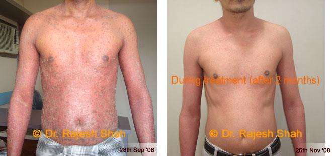 Psoriasis Before and After Case Photo