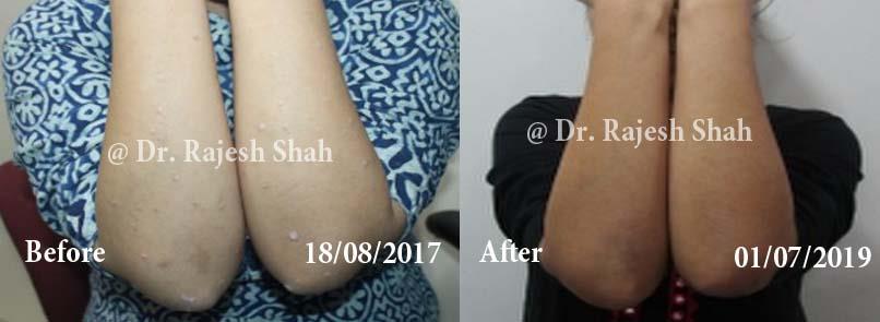 Psoriasis Before and After Case Photo