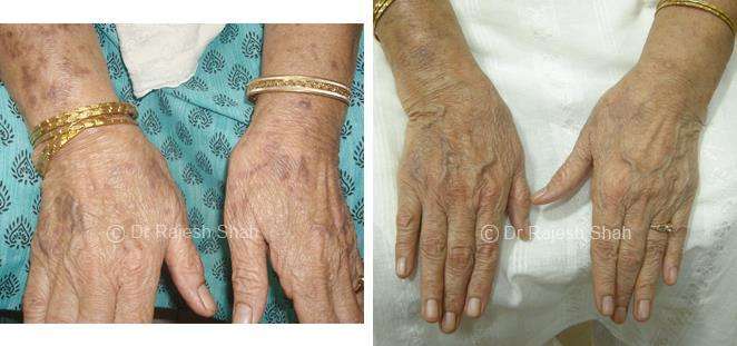 Lichen Planus Before and After Case Photo