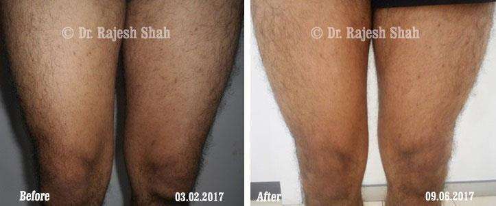 Lichen Planus Before and After Case Photo