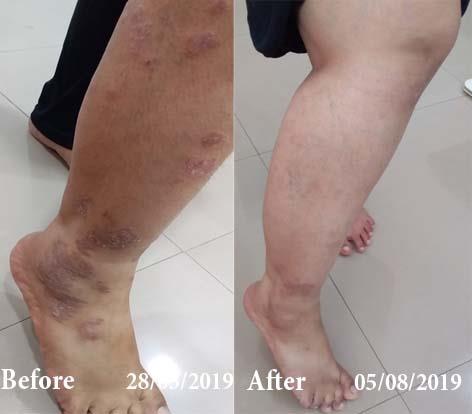 Psoriasis Before and After Case Photo