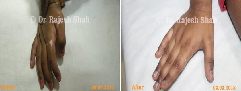Vitiligo Before and After Case Photo