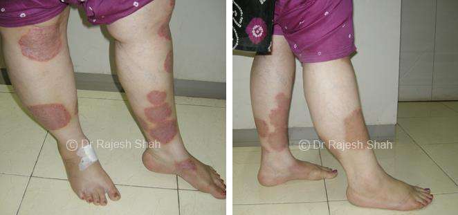 Psoriasis Before and After Case Photo