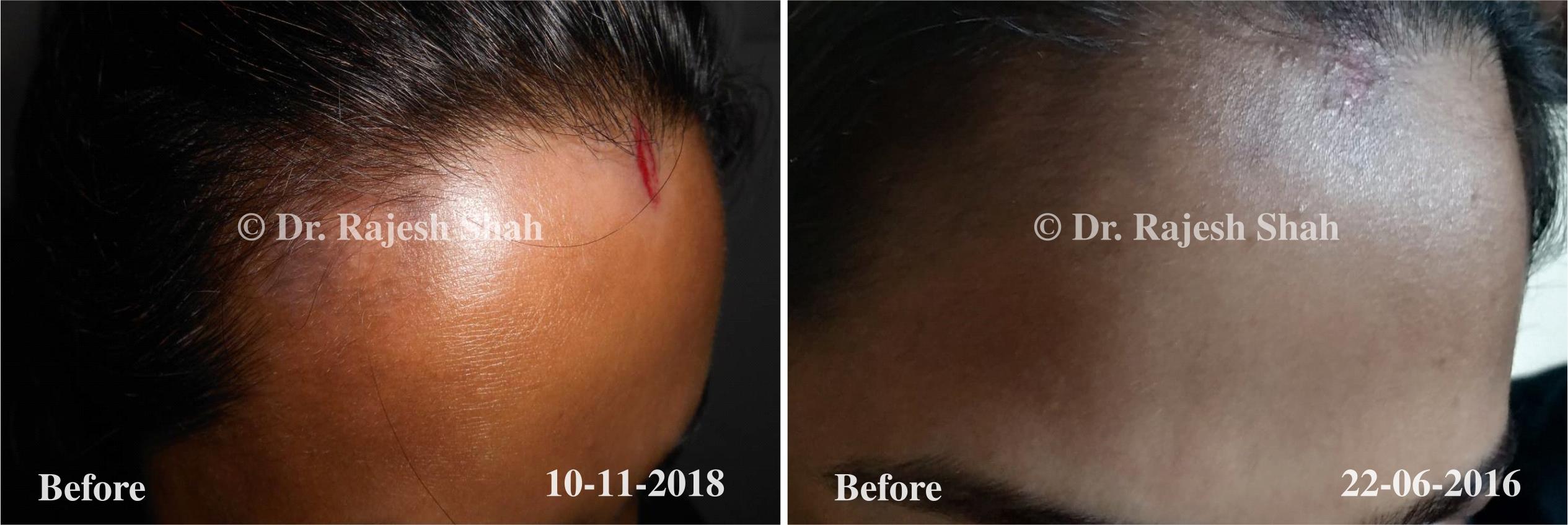 Vitiligo Before and After Case Photo