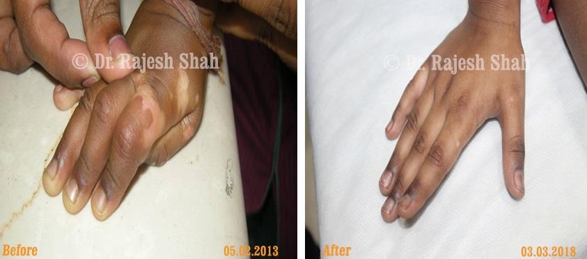 Vitiligo Before and After Case Photo