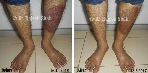 Psoriasis Before and After Case Photo