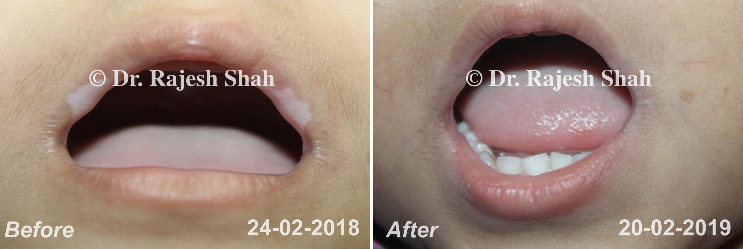 Before and After Case Photo