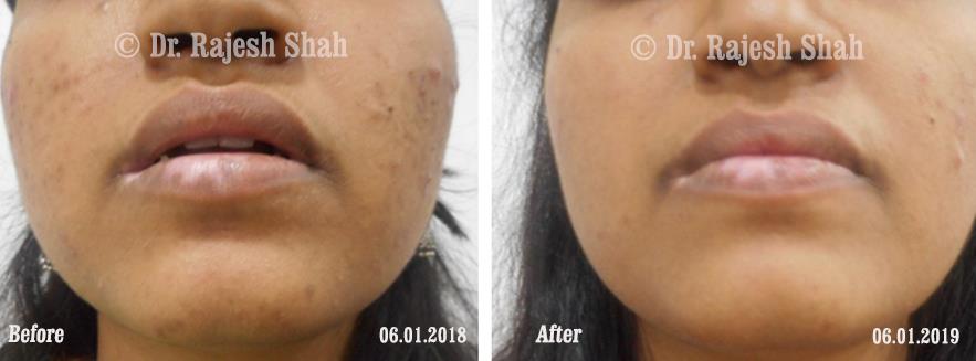 Acne Before and After Case Photo