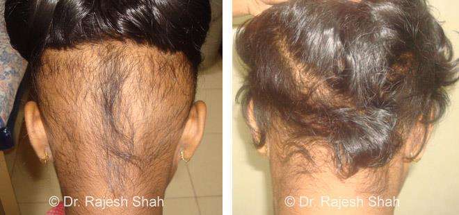 Alopecia Areata Before and After Case Photo