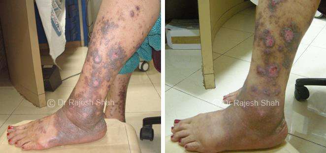 Lichen Planus Before and After Case Photo
