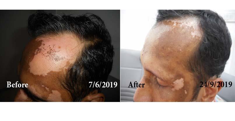 Vitiligo Before and After Case Photo
