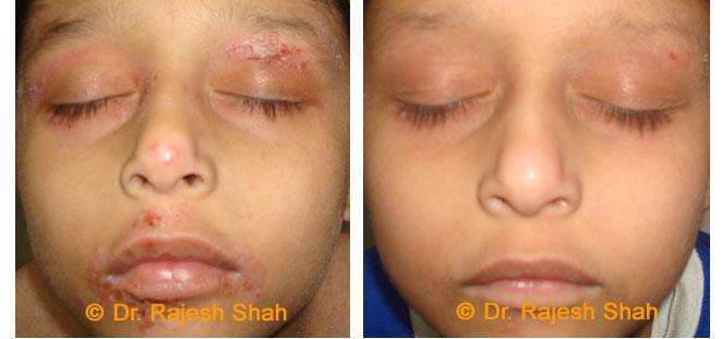 Eczema Before and After Case Photo