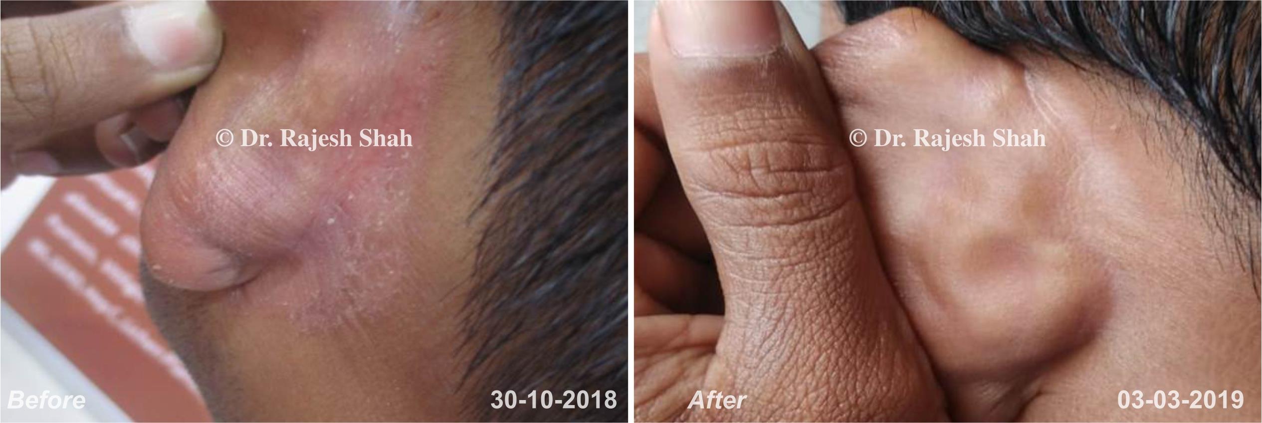 Psoriasis Before and After Case Photo