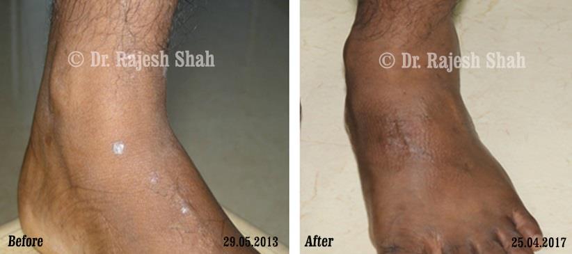 Lichen Planus Before and After Case Photo