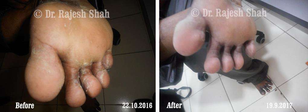Psoriasis Before and After Case Photo