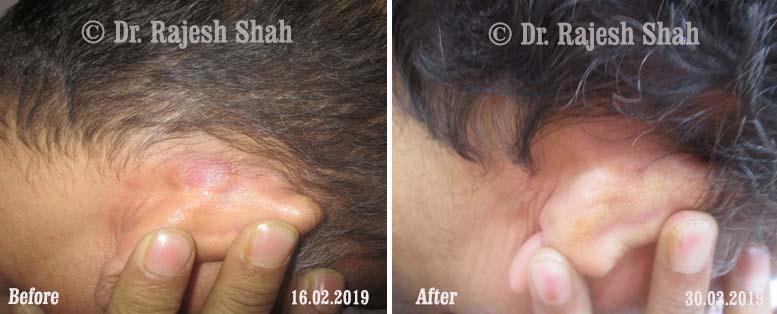 Psoriasis Before and After Case Photo