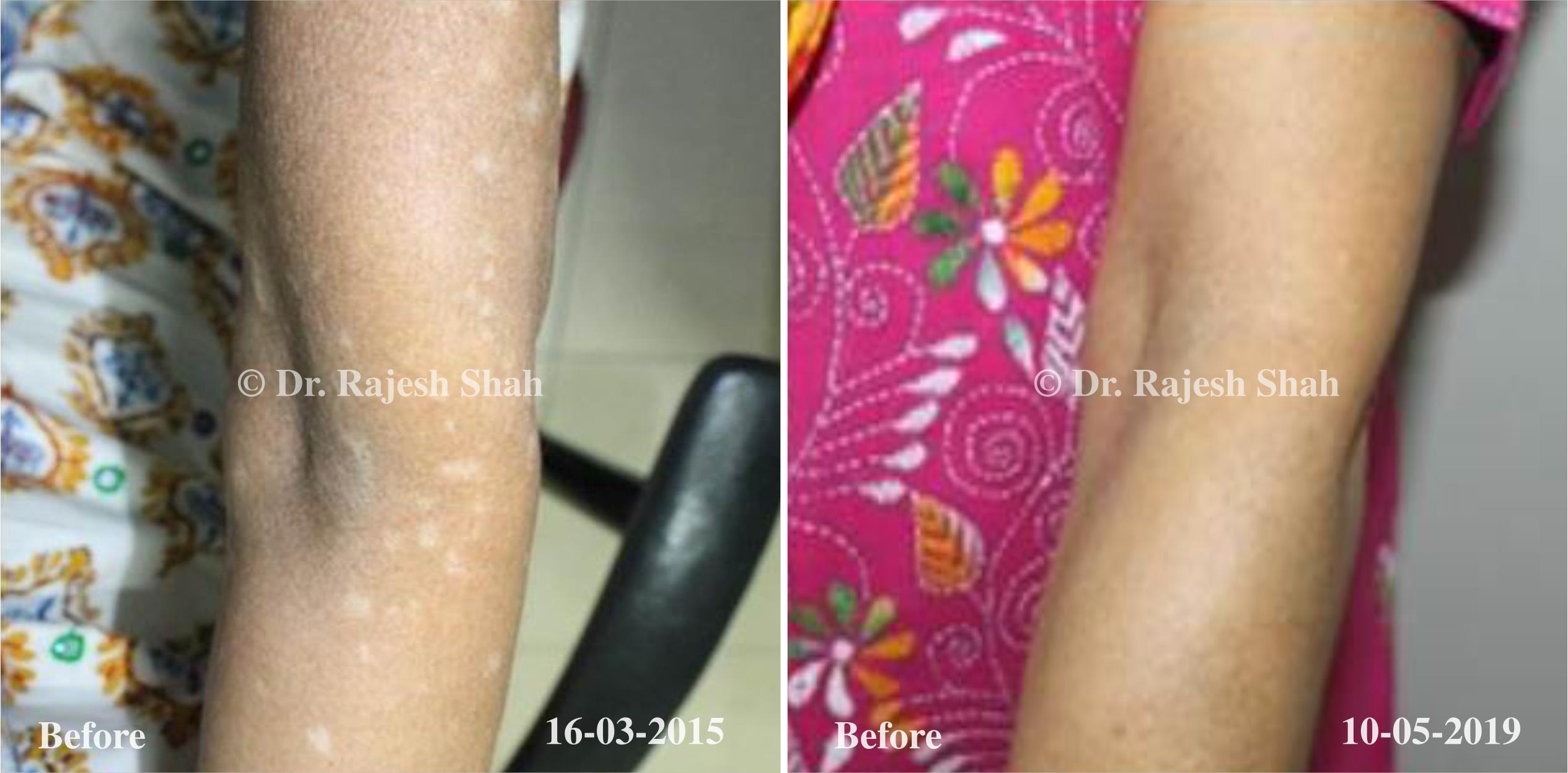Vitiligo Before and After Case Photo