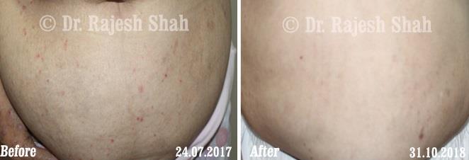 Lichen Planus Before and After Case Photo