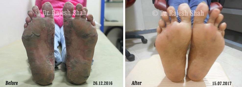 Psoriasis Before and After Case Photo