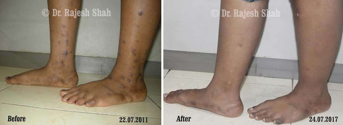 Lichen Planus Before and After Case Photo