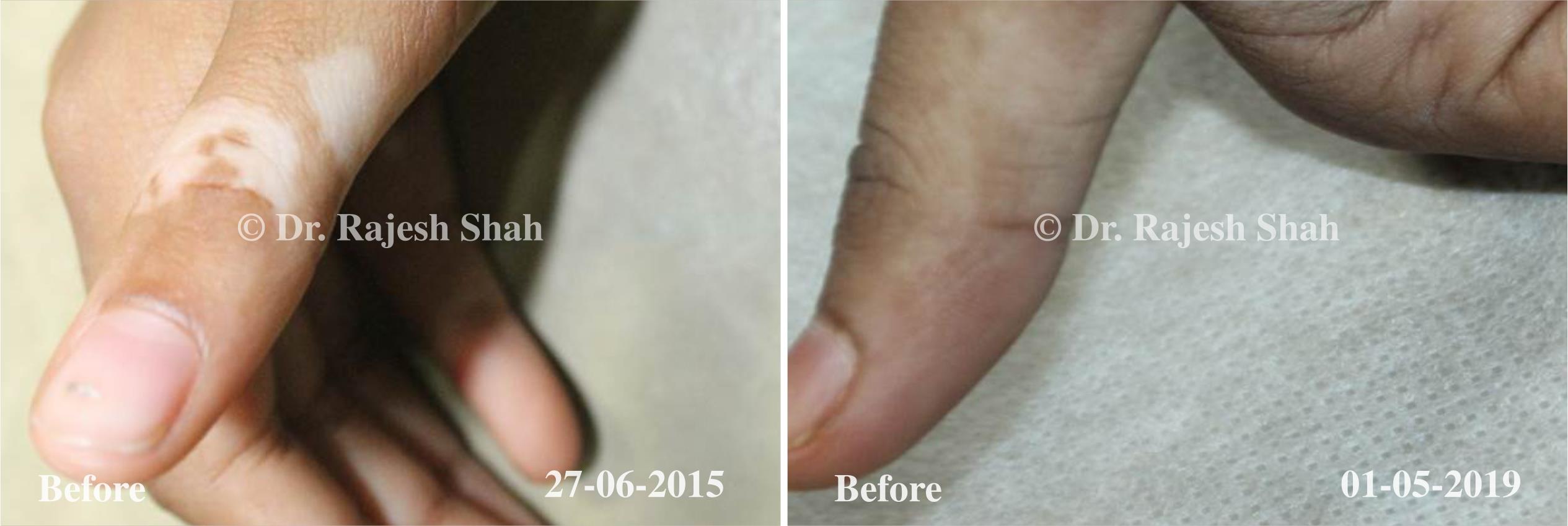 Vitiligo Before and After Case Photo