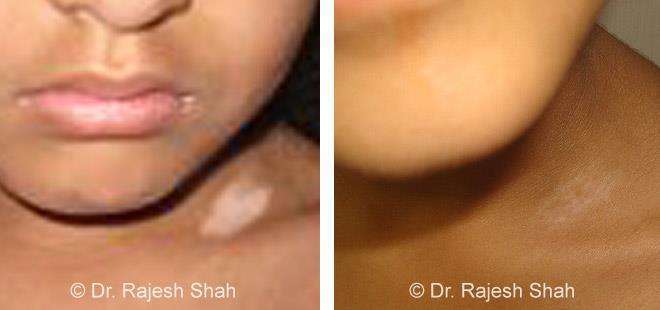 Vitiligo Before and After Case Photo