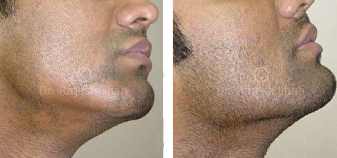 Alopecia Areata Before and After Case Photo