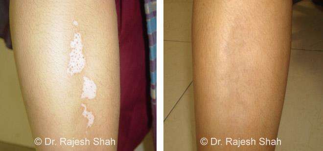 Vitiligo Before and After Case Photo