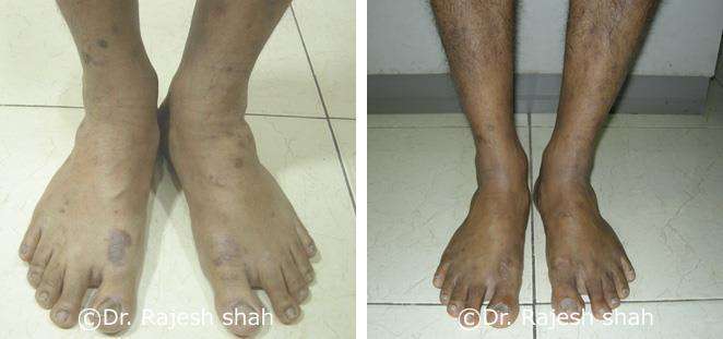 Psoriasis Before and After Case Photo