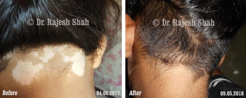 Vitiligo Before and After Case Photo