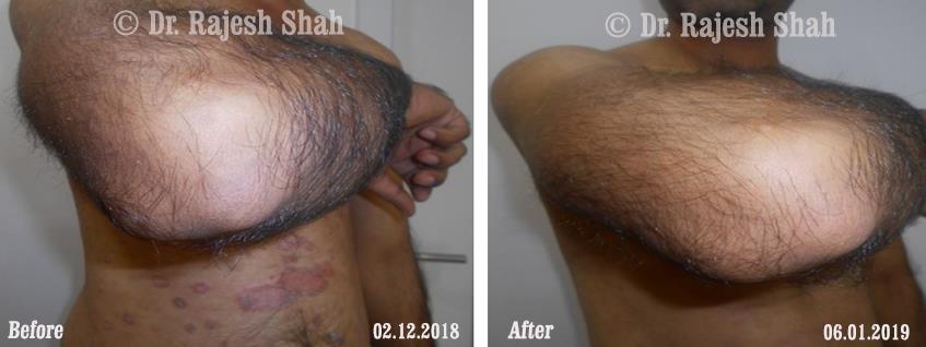 Psoriasis Before and After Case Photo