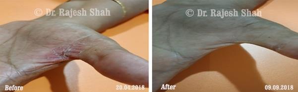 Psoriasis Before and After Case Photo