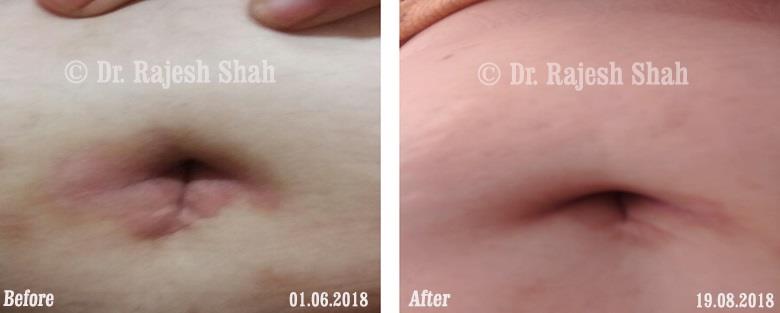 Psoriasis Before and After Case Photo