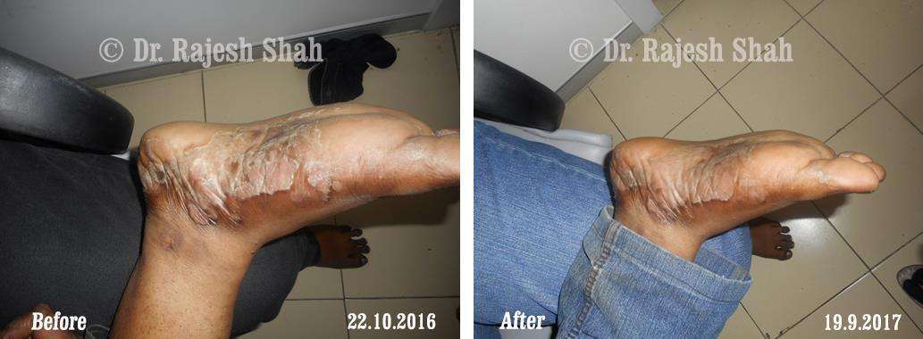 Psoriasis Before and After Case Photo